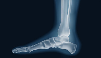 Ankle Pain 