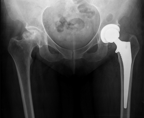 Hip replacement