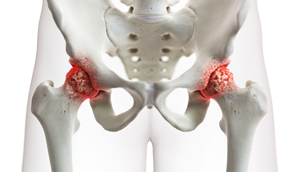 hip arthritis