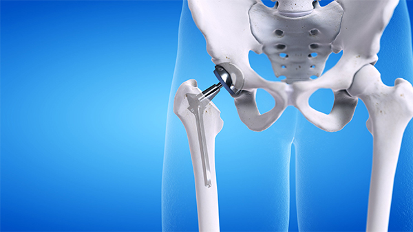 hip replacement