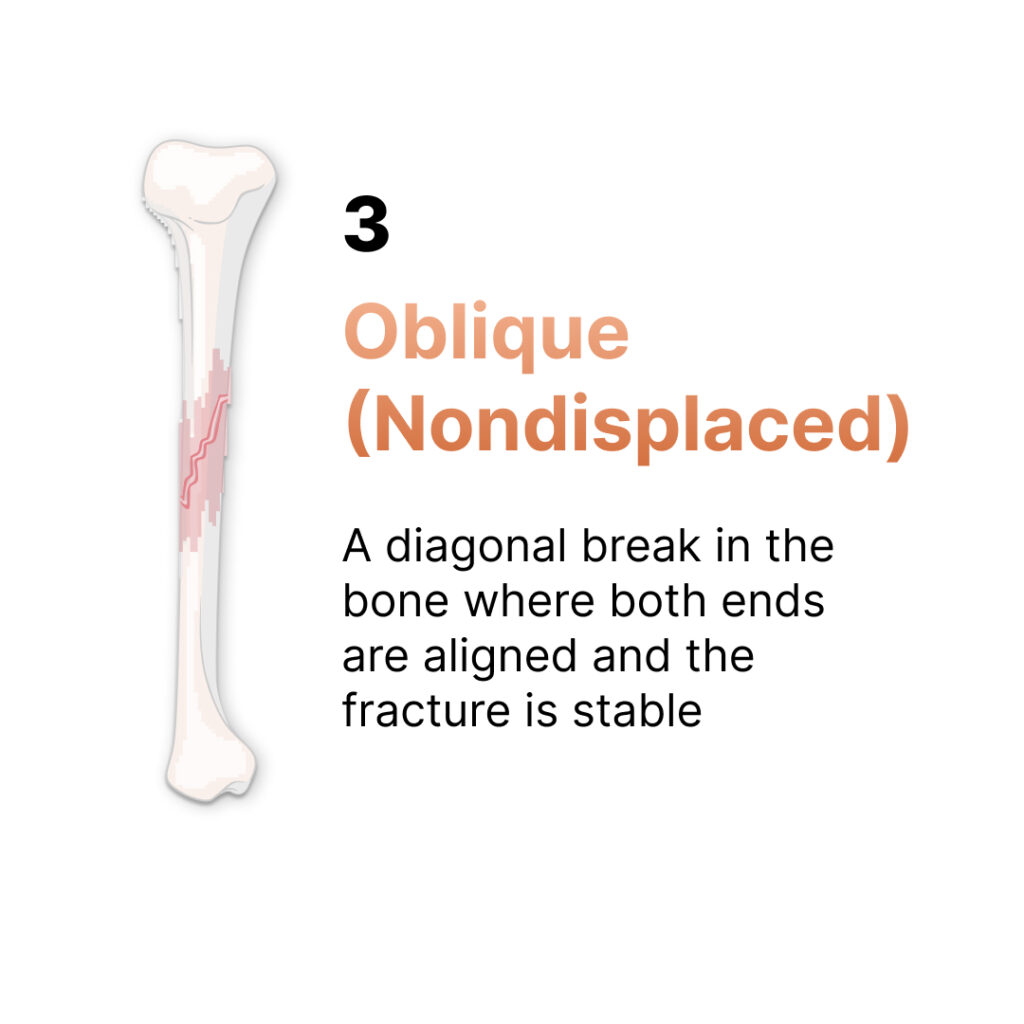 oblique fracture