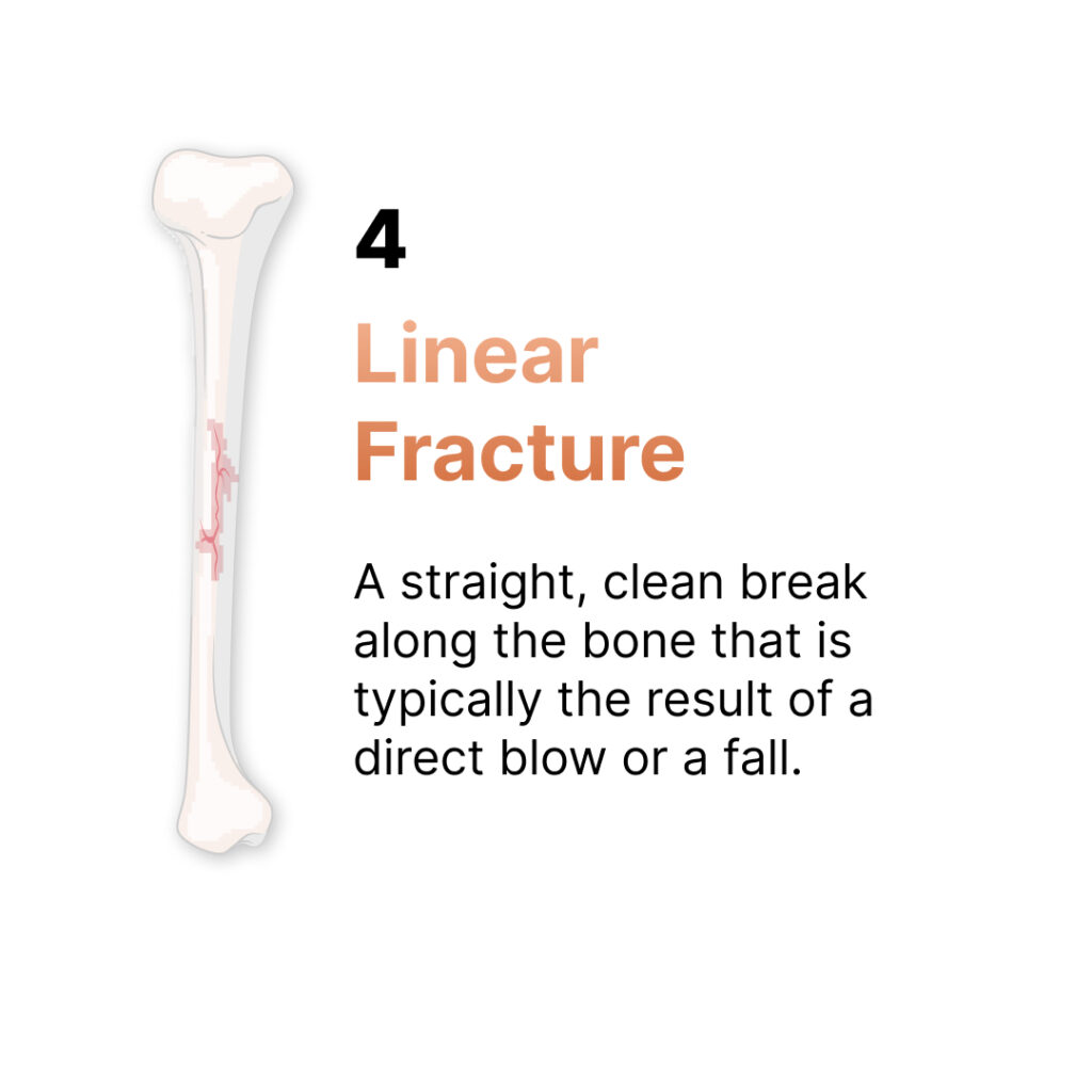 linear bone fracture