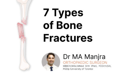 7 Types of bone fractures
