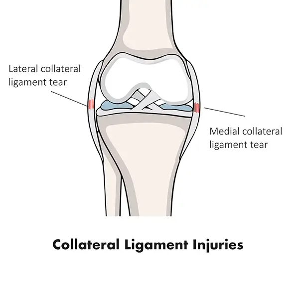 Collateral Ligament Injuries