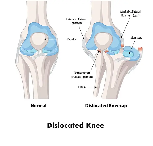 Dislocated Knee