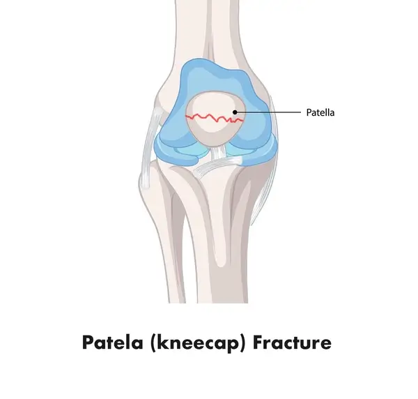 Patela fracture