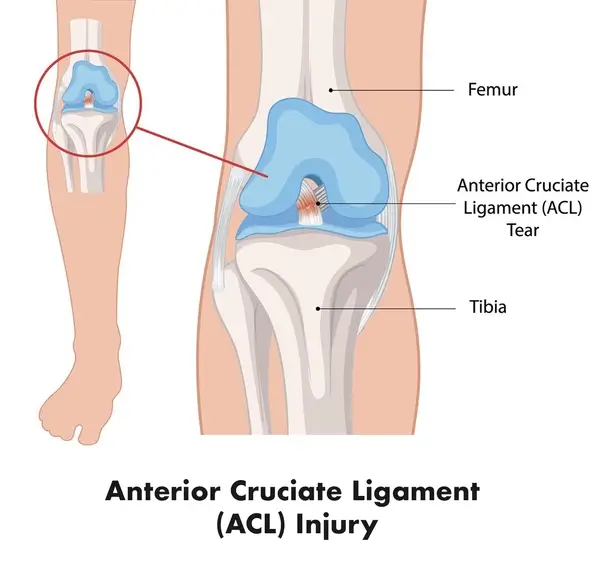 anterior cruciate ligament ACL injury illustration