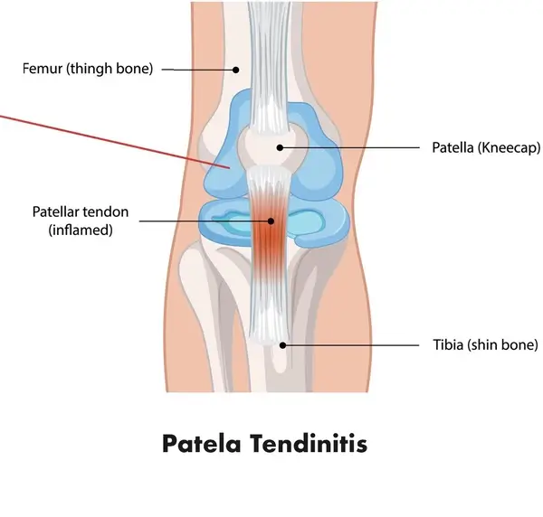 patellar tendinitis illustration