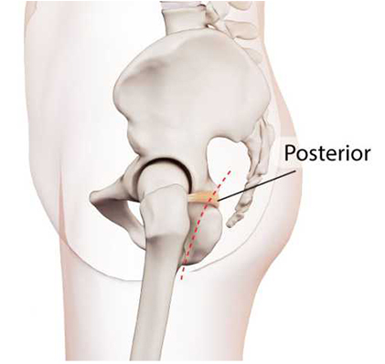 Posterior Approach Hip Replacement Durban