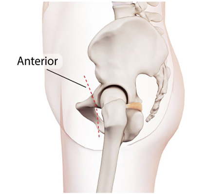 anterior approach hip replacement