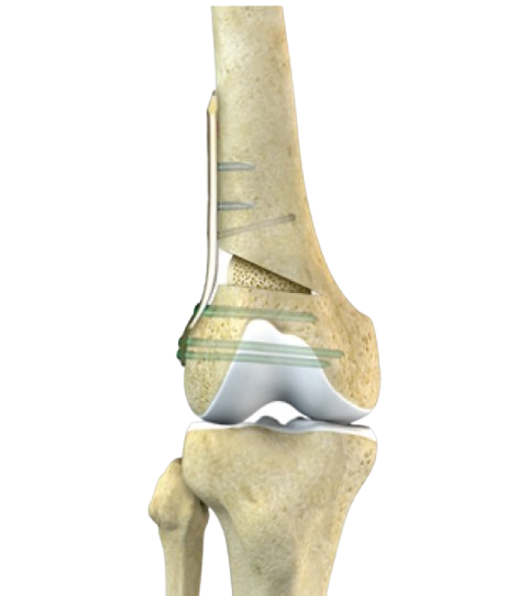 anterior approach hip replacement