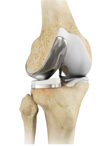 Partial knee replacement