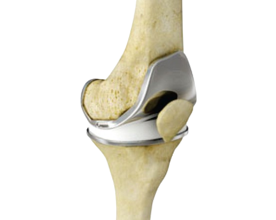 Total knee replacements (Arthroplasty) 