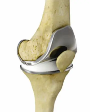 total knee replacement 3d rendered image Durban