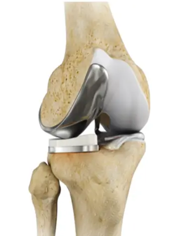 partial knee replacement Durban 3d rendered image