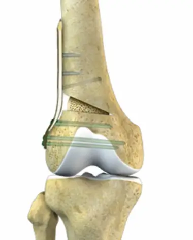 Knee Osteotomy 3d render